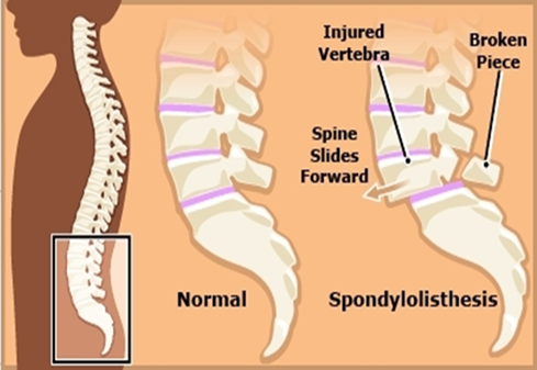 What is Spondylolisthesis? - Image 1