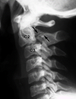What is Spondylolisthesis? - Image 2