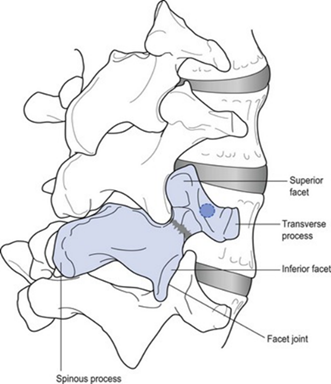 What is Spondylolysis? - Image 6